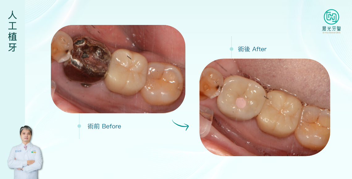 告別銀⾊⾦屬假牙!